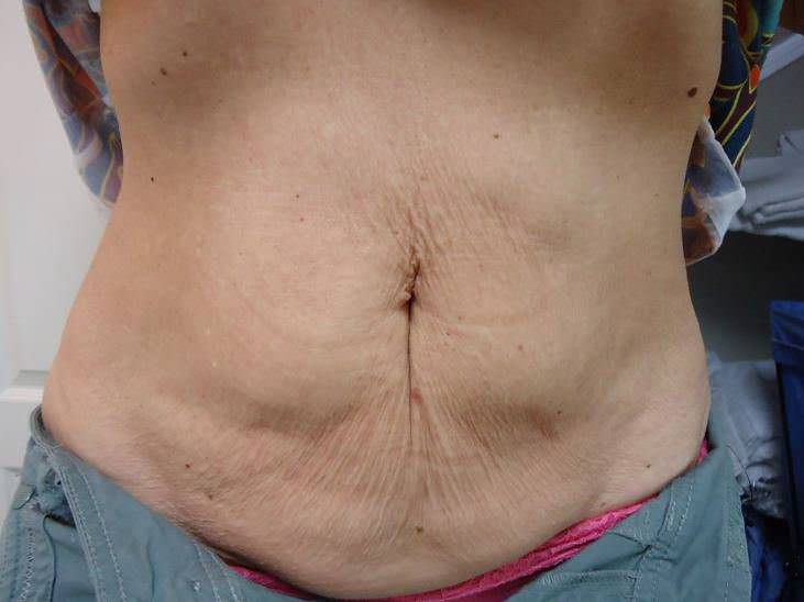 VelaShape-brzuch-przed